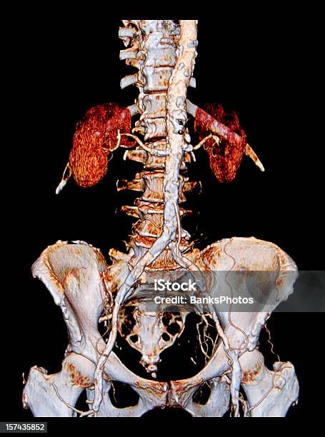 3 D Брюшная Аорта Компьютерная Томография С Обширной Атеросклероз — стоковые фотографии и другие картинки Магнитно-резонансная томография