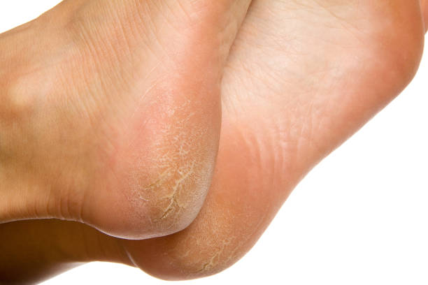 Dry and cracked soles of feet on white background  human foot stock pictures, royalty-free photos & images