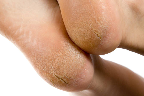 seca e rachada solas dos pés em fundo branco - human foot - fotografias e filmes do acervo