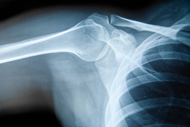 Shoulder X-ray stock photo
