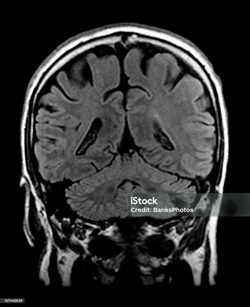 Head Magnetresonanztomographie des Gehirns mit sichtbaren Kleinhirn - Lizenzfrei Magnetresonanztomographie Stock-Foto