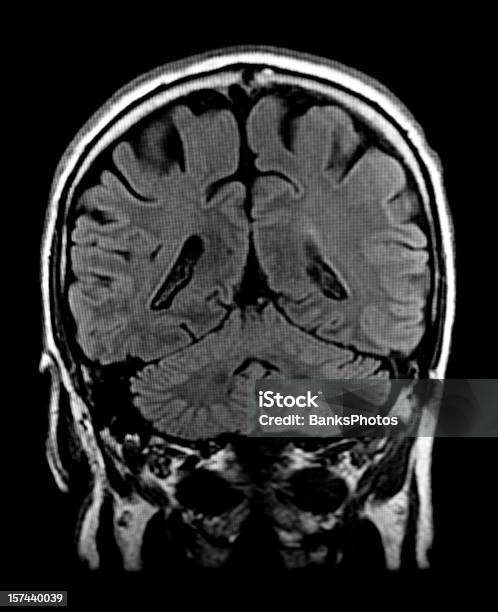 Head Magnetresonanztomographie Des Gehirns Mit Sichtbaren Kleinhirn Stockfoto und mehr Bilder von Magnetresonanztomographie