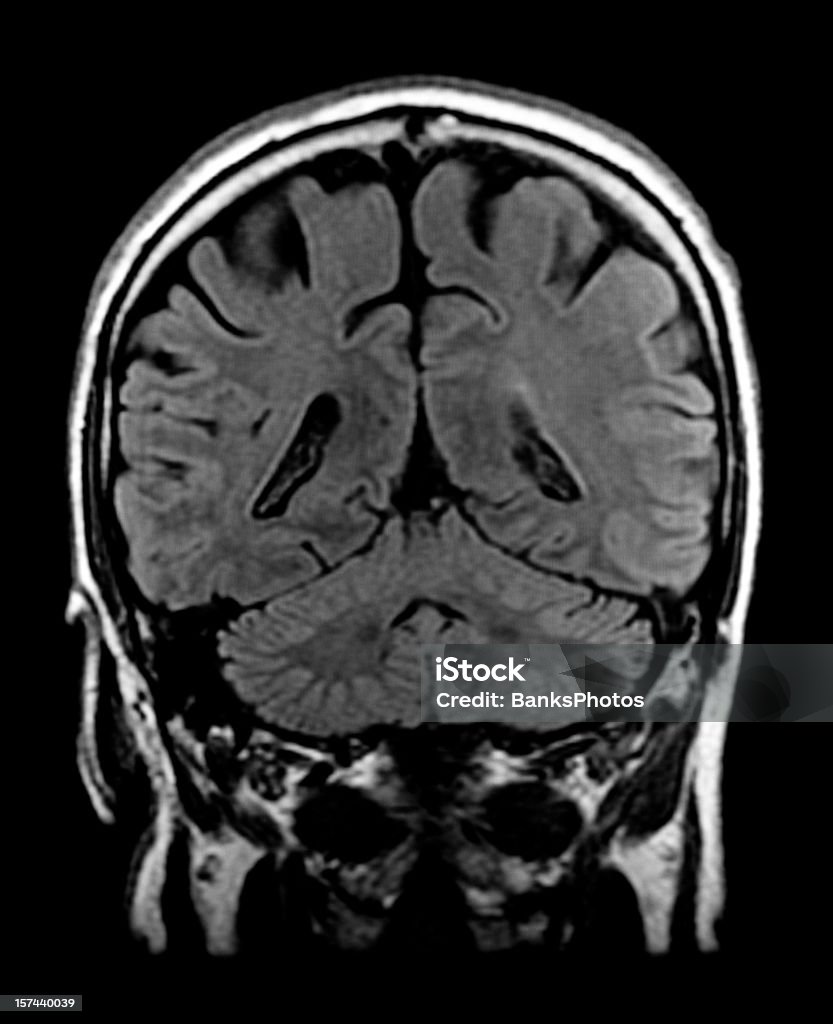 Image à résonance magnétique de tête avec cerveau Visible Cervelet - Photo de Image par résonance magnétique libre de droits