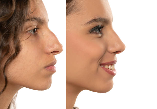 Woman Rhinoplasty. Women Nose Shape Before and After Plastic Surgery. Woman Profile Side View over isolated White Background Woman Rhinoplasty. Women Nose Shape Before and After Plastic Surgery. Woman Profile Side View over isolated White Studio Background teenage girl before and after make up stock pictures, royalty-free photos & images