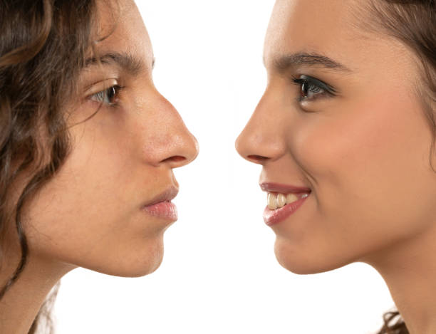 Woman Rhinoplasty. Women Nose Shape Before and After Plastic Surgery. Woman Profile Side View over isolated White Background Woman Rhinoplasty. Women Nose Shape Before and After Plastic Surgery. Woman Profile Side View over isolated White Studio Background teenage girl before and after make up stock pictures, royalty-free photos & images