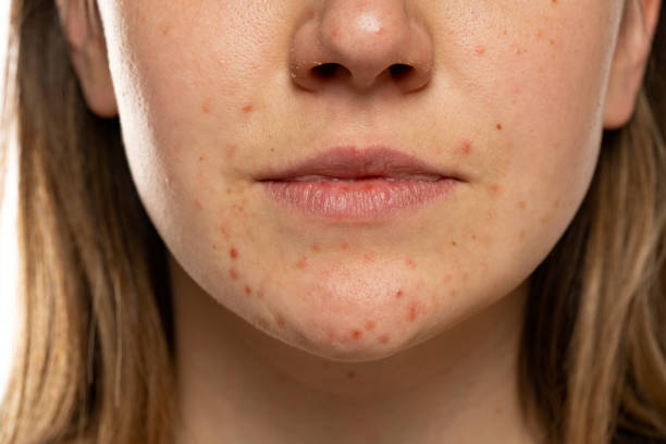 istock Young woman with the pimples on her face. Problematic skin 1574474491