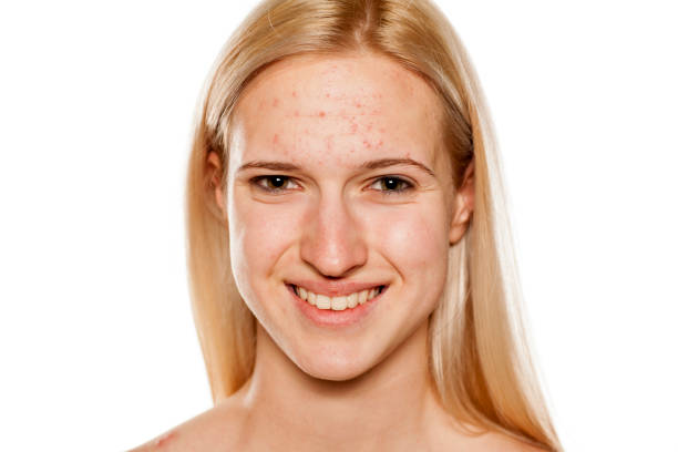 istock Young smiling blond with pimples on her forehead 1574681970
