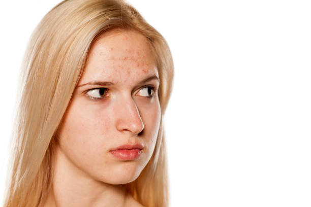 istock The young blonde with pimples on her forehead and with a skeptical look 1574682194