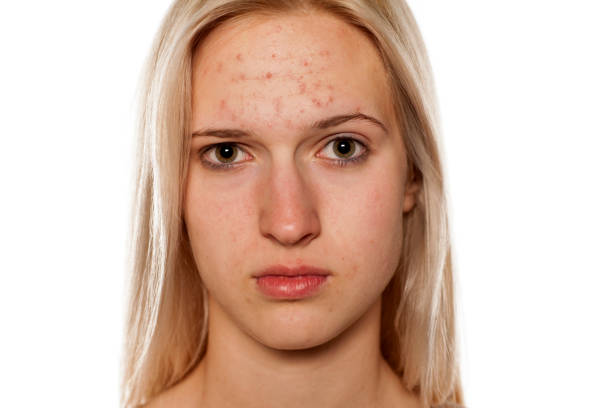 istock Young blonde with pimples on her forehead 1574682389