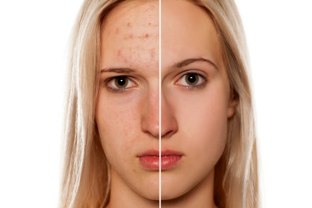 istock Comparative portrait of female face, before and after cosmetic treatment 1574683079