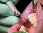 Closeup of laser etching teeth procedure