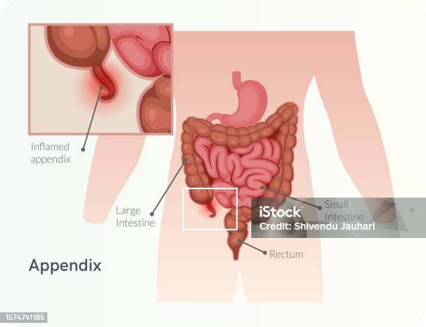 Appendix Spasm Appendicitis Inflamed Appendix Stock Illustration Stock Illustration ...