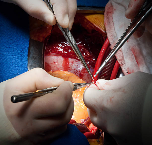 istock Cardiac Surgery CABG Vein Anastomosis 157478664
