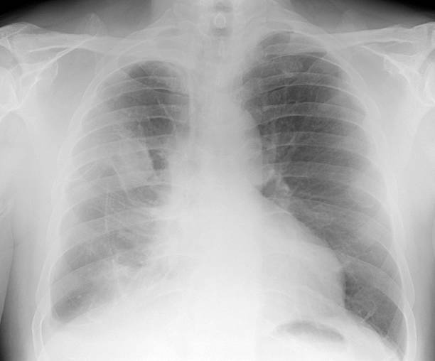 디지탈 흉부 x-ray 석면 관련 늑막 명판 및 중피종 스톡 사진