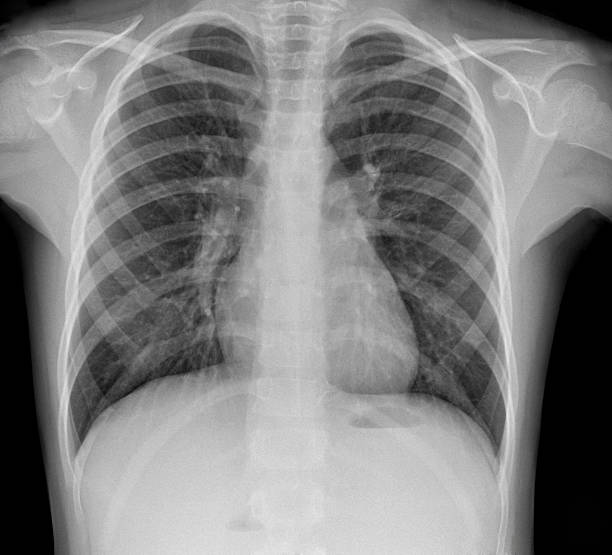 radiografía de la neumonía - rib cage fotografías e imágenes de stock