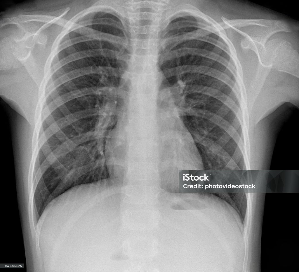 Pneumonia X-ray  Tuberculosis Bacterium Stock Photo