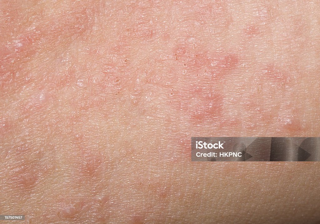 붉은 피부 발진, 부딪힘, Scabs & 뾰루지 치료에 특화된 클렌저 하위 - 로열티 프리 건조한 스톡 사진