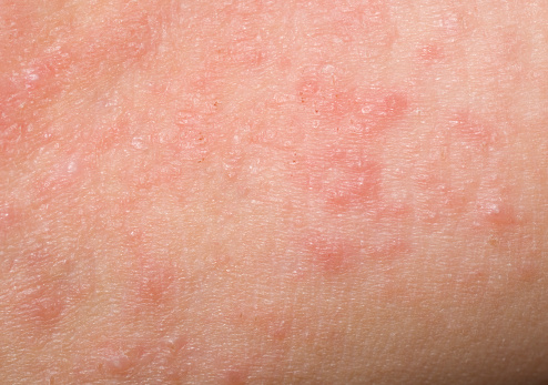 Shown here is a bumpy red skin rash on a child’s arm.