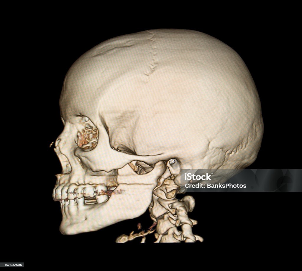 3 D crânio vista lateral Tomografia Computorizada - Royalty-free Tridimensional Foto de stock