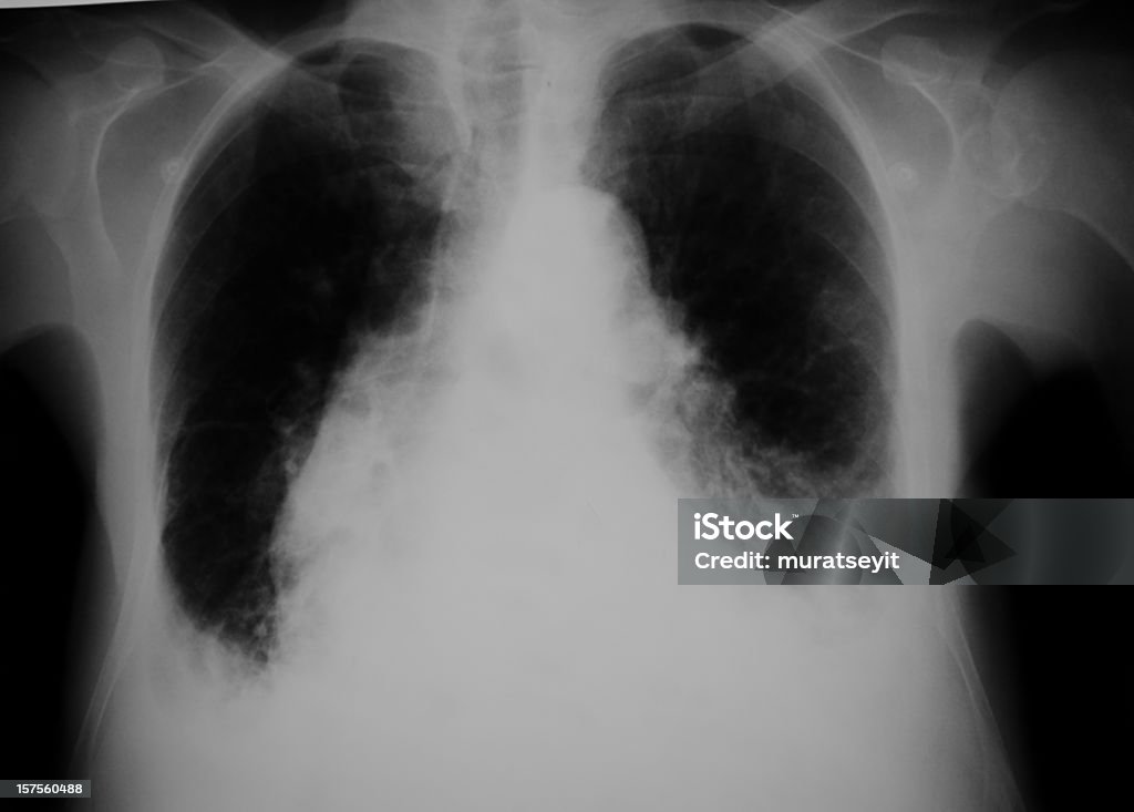 Radiografía pulmonar de la insuficiencia cardíaca - Foto de stock de Fumar - Temas sociales libre de derechos