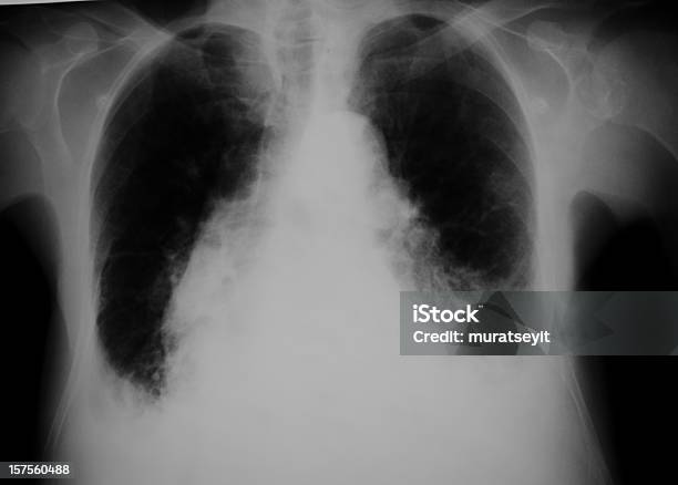 Radiografía Pulmonar De La Insuficiencia Cardíaca Foto de stock y más banco de imágenes de Fumar - Temas sociales - Fumar - Temas sociales, Imagen de rayos X, Resfriado y gripe