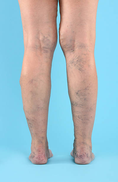 Varicose Vien on legs and feet stock photo