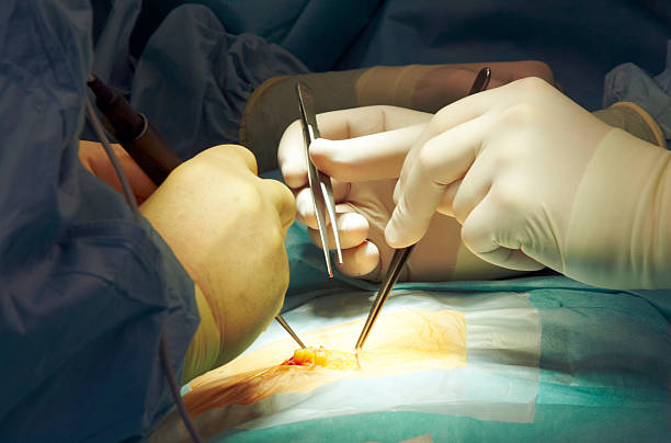 Close up of gloved hands performing surgery on patient Surgery in a german hospital (hernia). hernia photos stock pictures, royalty-free photos & images