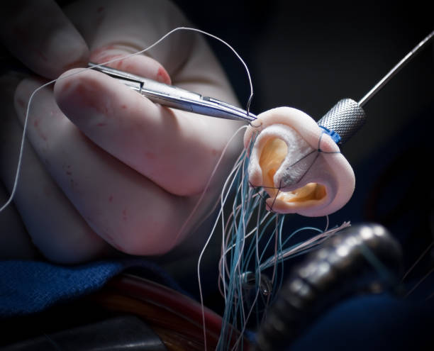valvule mitrale remplacement opération du coeur - valvule cardiaque photos et images de collection