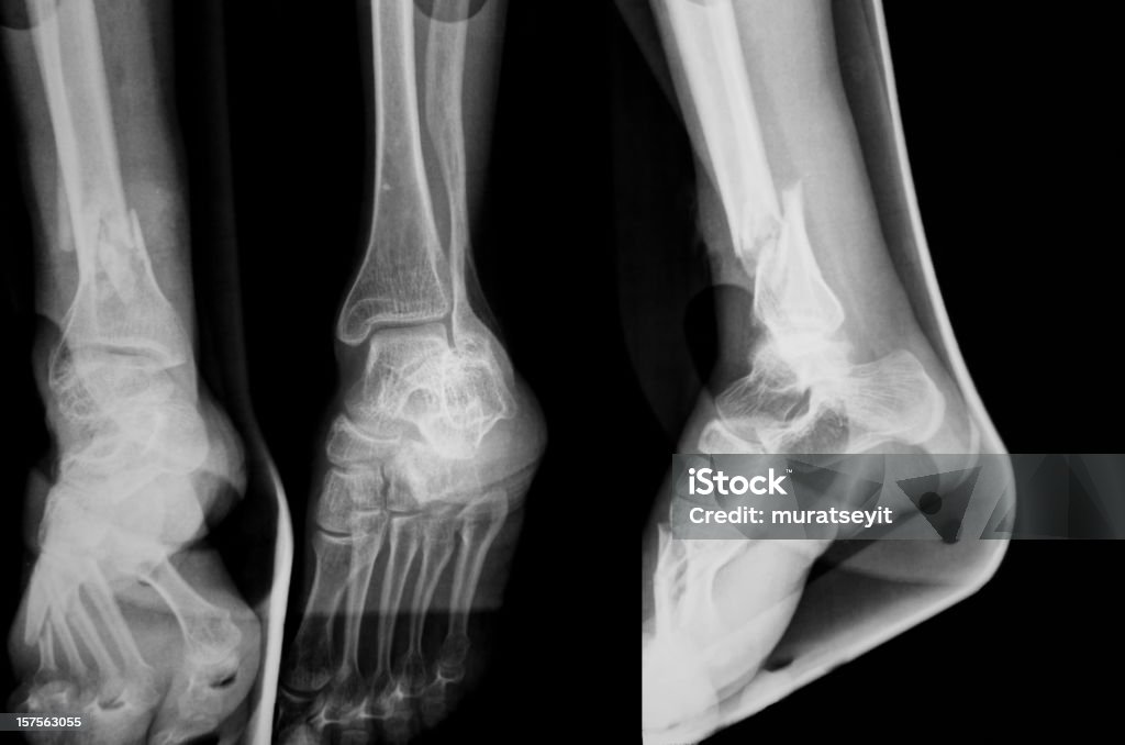 x-ray imágenes de una pierna fracturada XXXL - Foto de stock de Imagen de rayos X libre de derechos