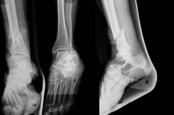 x-ray images of a broken leg XXXL stock photo