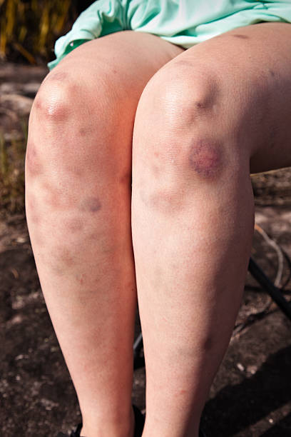 Bruise injuries Young woman scrubbing healing cream on multiple leg bruises knee contusion bruised knee stock pictures, royalty-free photos & images
