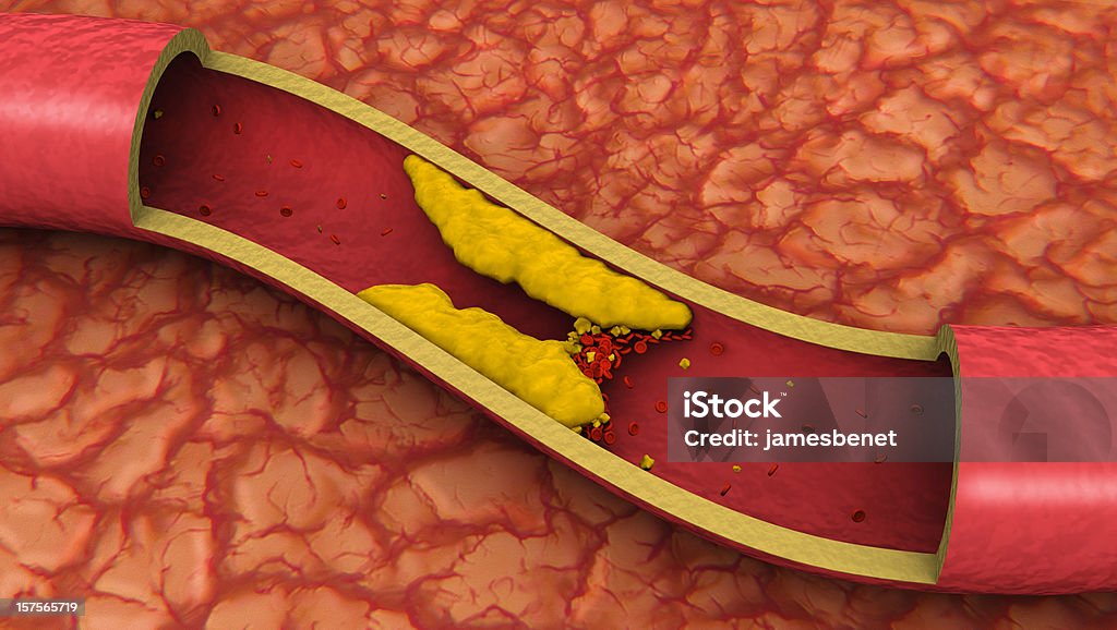 Clogged Artery (3D)  Cholesterol Stock Photo