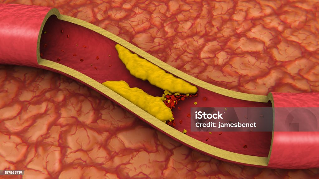 Zatkane tętnicy) (3D - Zbiór zdjęć royalty-free (Cholesterol)