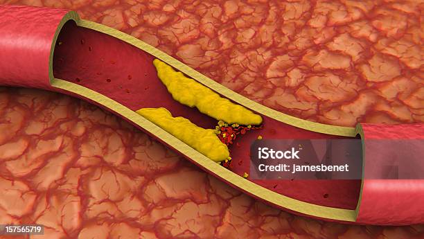 Zatkane Tętnicy 3d - zdjęcia stockowe i więcej obrazów Cholesterol - Cholesterol, Zakrzep, Komórka tłuszczowa