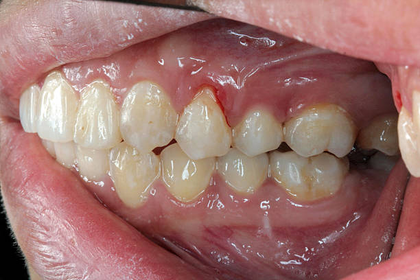 istock Gum Bleeding / Recession (Left Side View) 157566048