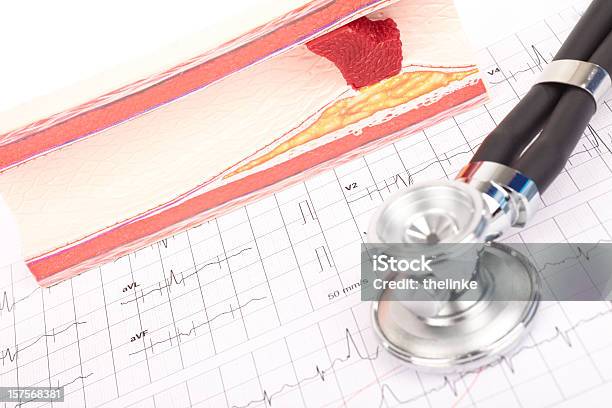 Modelo De Arteriosclerosis Ecg Y Estetoscopio Foto de stock y más banco de imágenes de Coágulo de sangre - Coágulo de sangre, Cardiopatía, Vaso sanguíneo