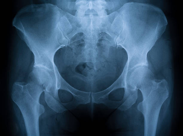 X-ray image of a hip  hip body part stock pictures, royalty-free photos & images