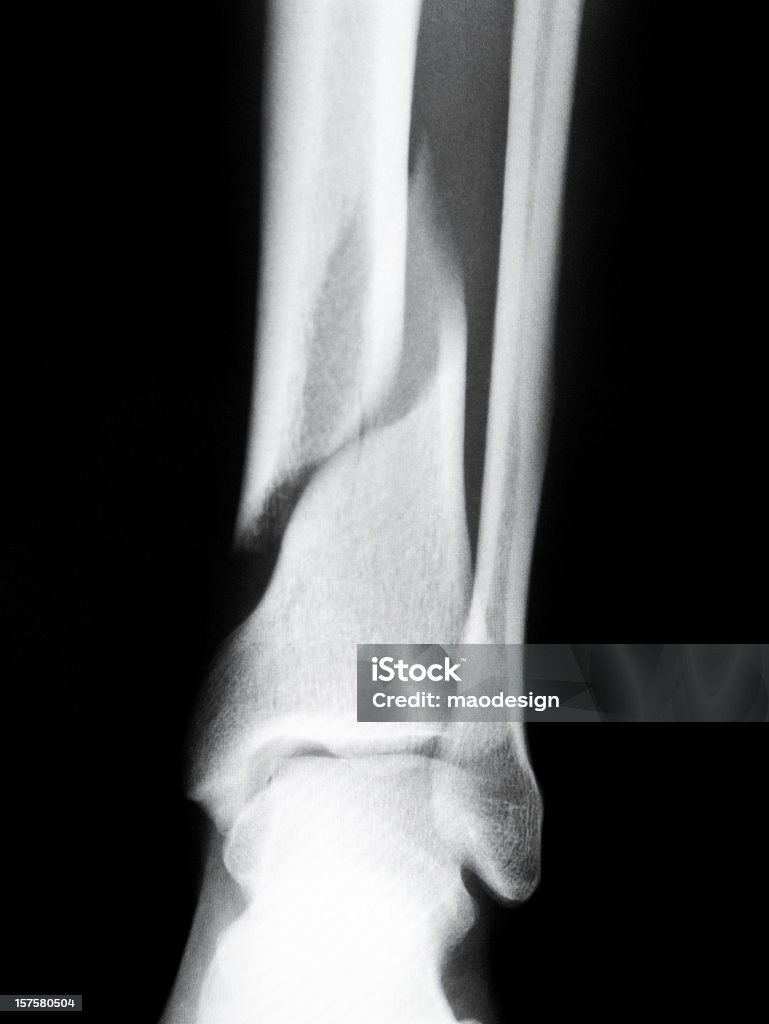 X 線の割れた人間の骨格 - 骨折のロイヤリティフリーストックフォト