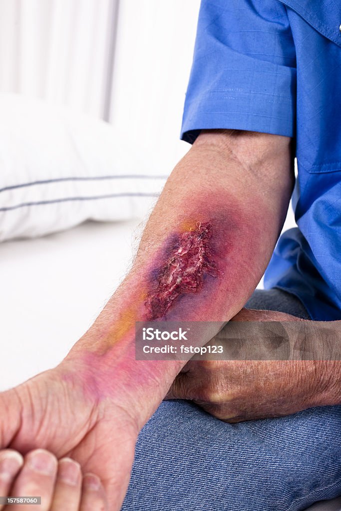 Ustioni gravi lesioni sul braccio dell'uomo. Pronto soccorso dell'ospedale. - Foto stock royalty-free di Bruciare