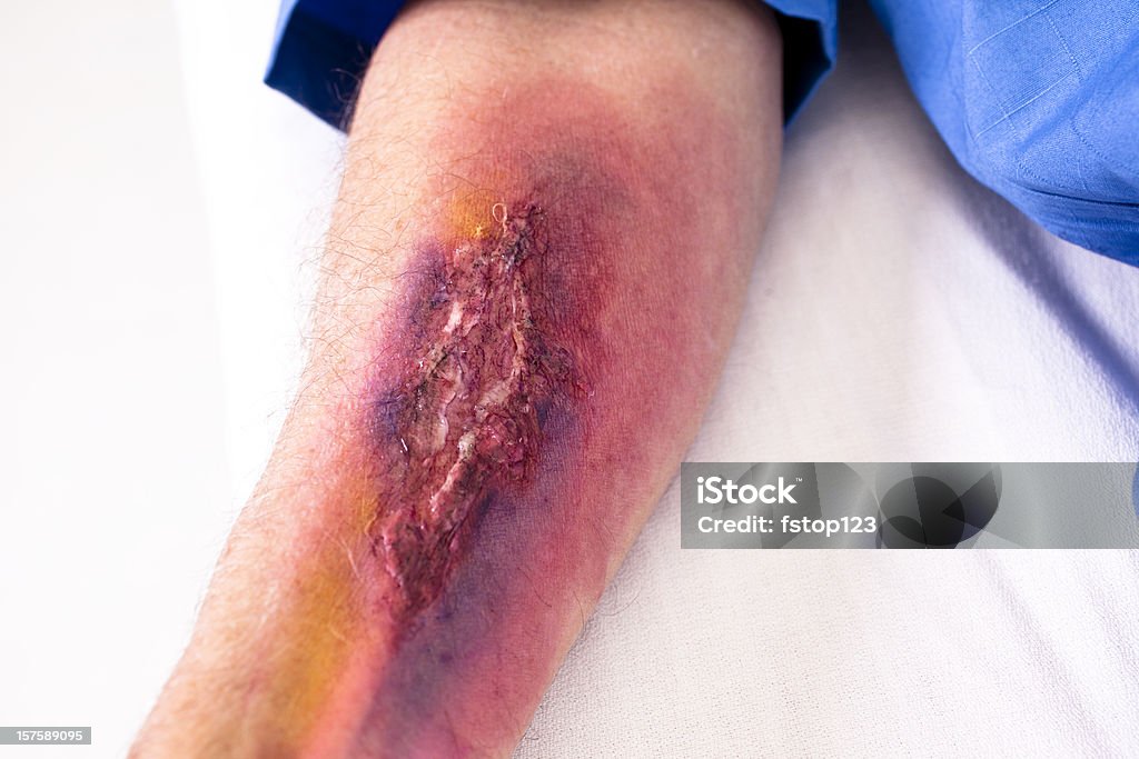 Serious burn injury on man's arm. Hospital emergency room. Serious burn injury on man's arm.   Hopsital emergency room. Close up. Wound Stock Photo