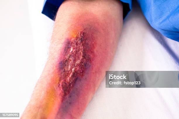 Serious Burn Injury On Mans Arm Hospital Emergency Room Stock Photo - Download Image Now