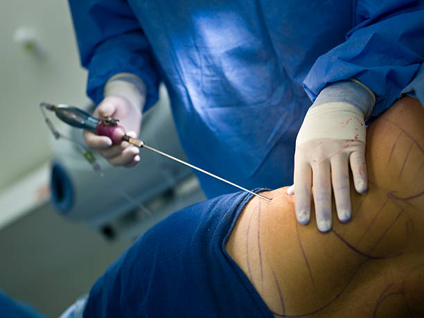 liposuccion - surgical needle photos photos et images de collection