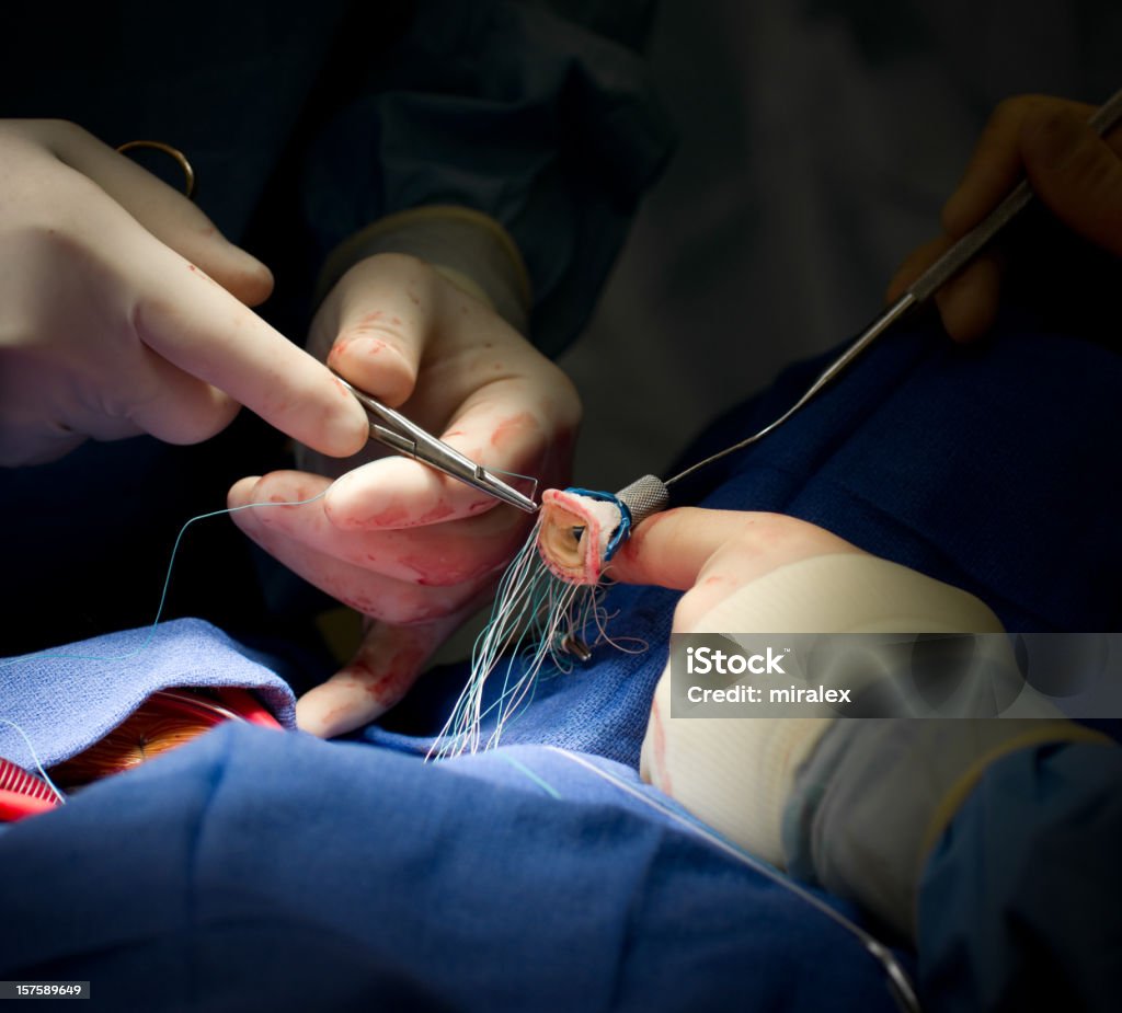 Intervento di chirurgia cardiaca valvola aortica sostituzione - Foto stock royalty-free di Sanità e medicina