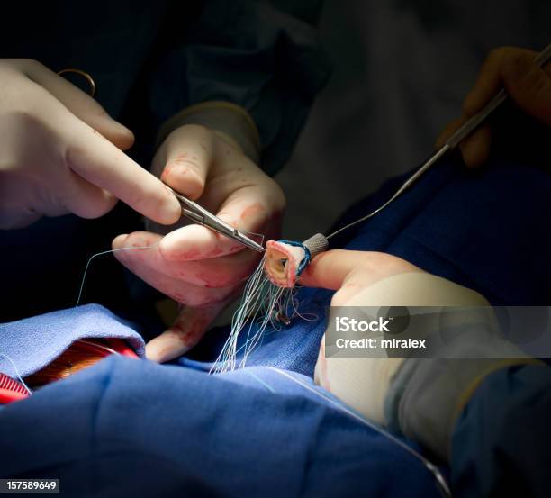 Intervento Di Chirurgia Cardiaca Valvola Aortica Sostituzione - Fotografie stock e altre immagini di Sanità e medicina