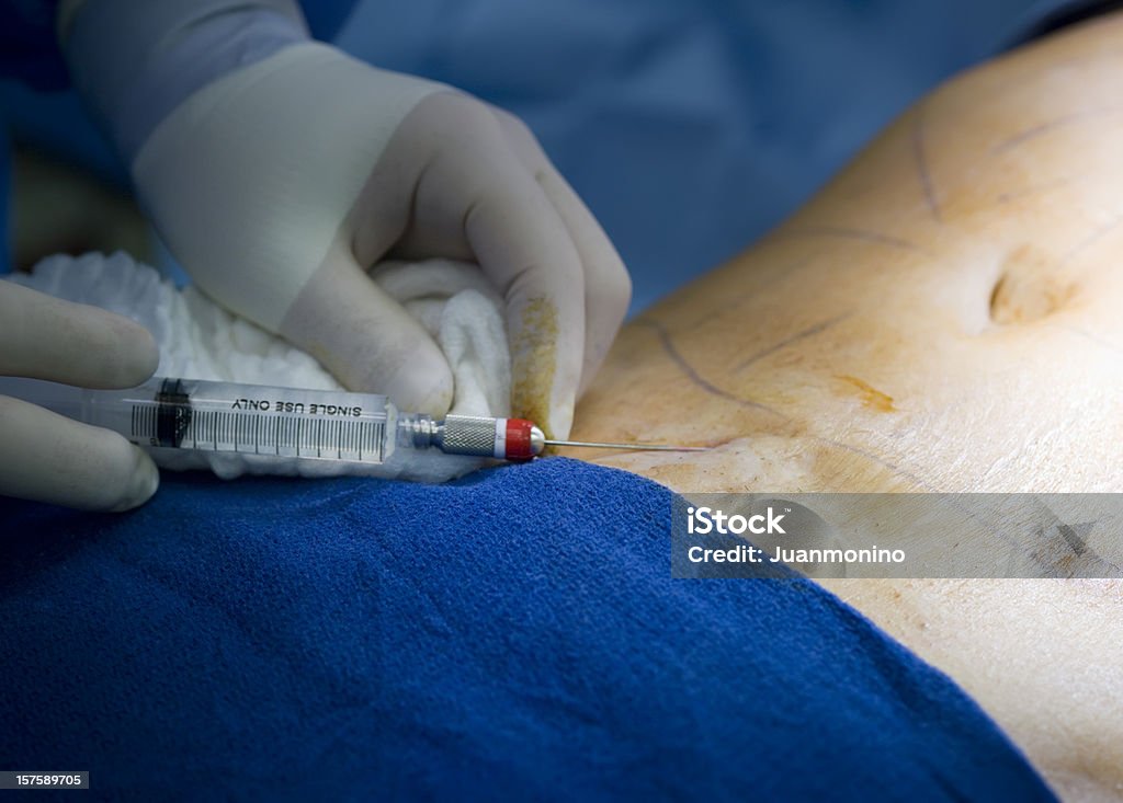 Делать инъекцию анестезией - Стоковые фото Липосакция роялти-фри