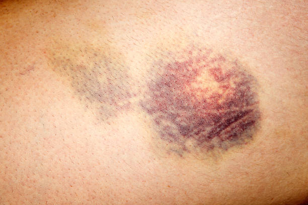 Close up of bruised skin on human leg  bruise photos stock pictures, royalty-free photos & images