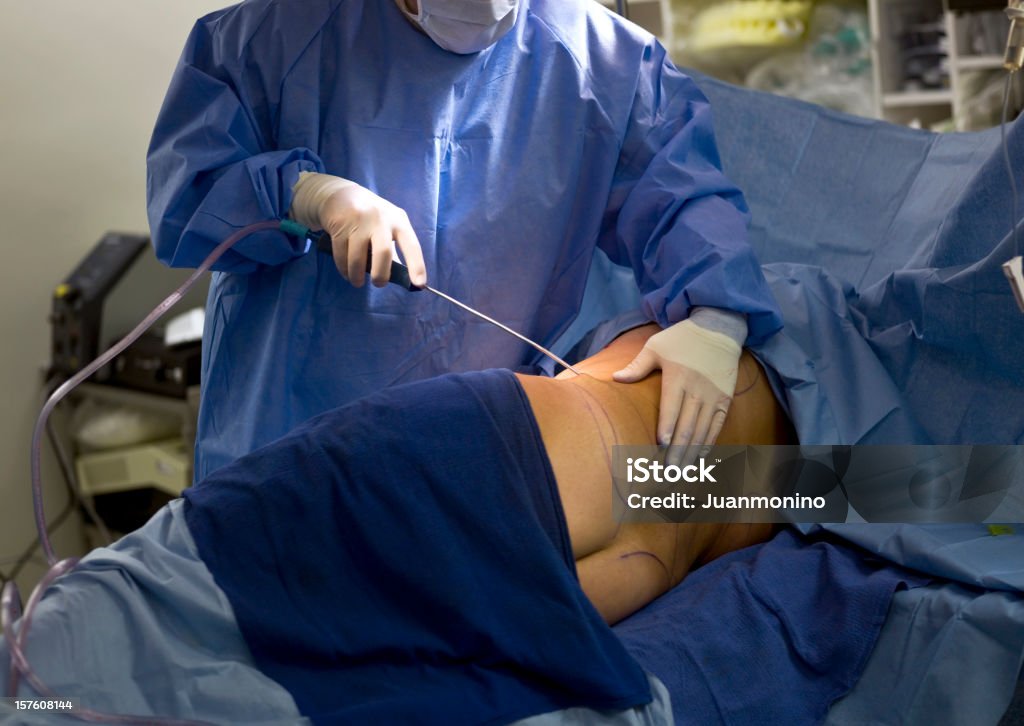 Liposuction Doctor performing a liposuction procedure in the operating room (this picture has been taken with a Hasselblad H3D II 31 megapixels camera) Plastic Surgery Stock Photo