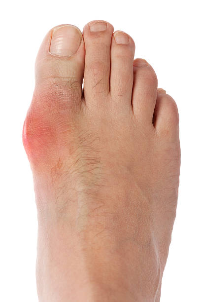 gout pied - big toe photos et images de collection