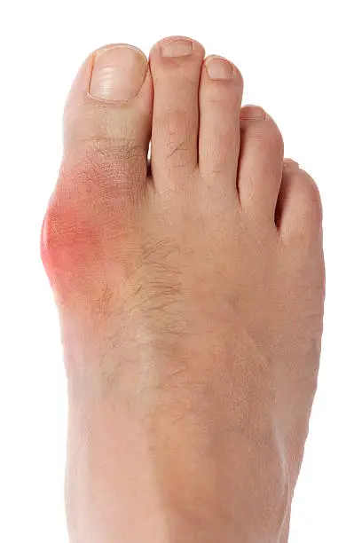 Toe joint swollen and red with a gout attack on foot