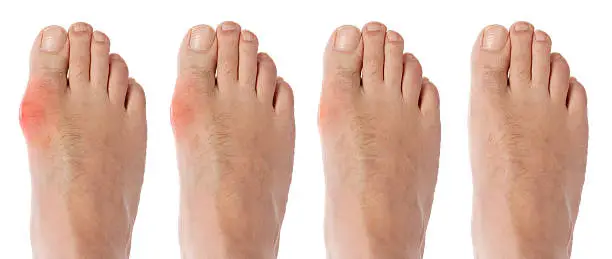 Healing process of gout arthritis on toe joint